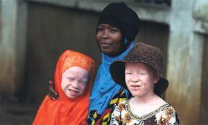 Türkiye Tanzanya’da albino köyü kuruyor
