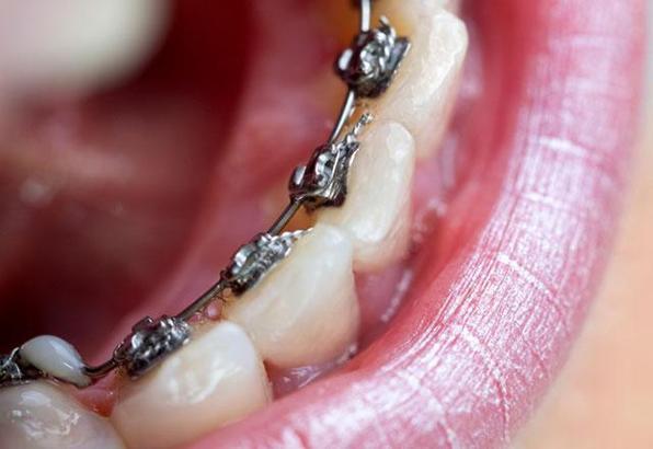 Diş teli temizliği nasıl yapılır? Sağlık Haberleri