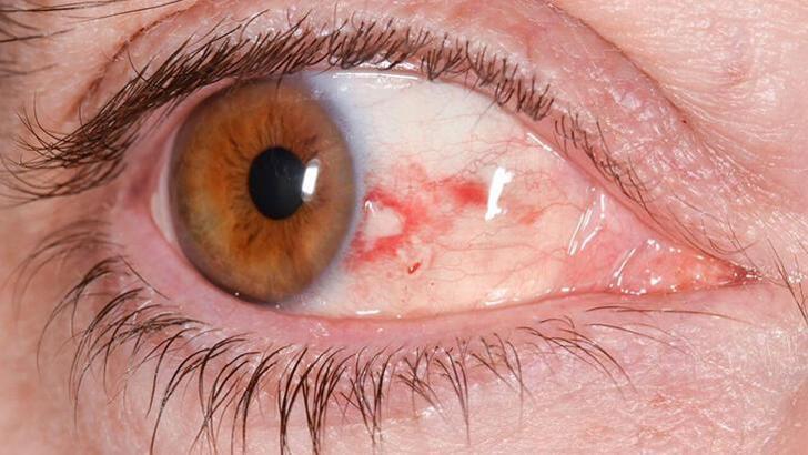 Göz tansiyonu (glokom) nedir? Göz tansiyonu nedenleri, belirtileri ve tedavisi…