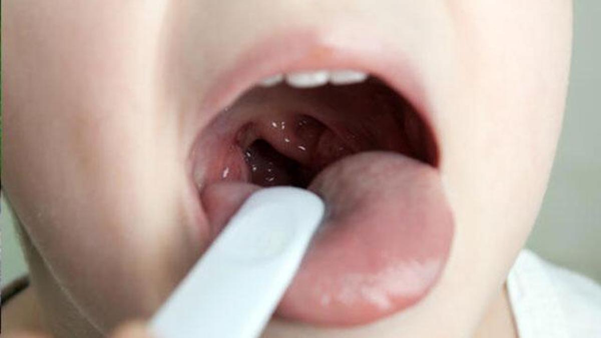 kriptik tonsillit nedir kriptik tonsillit bademcik iltihabi tedavisi nasil yapilir saglik haberleri