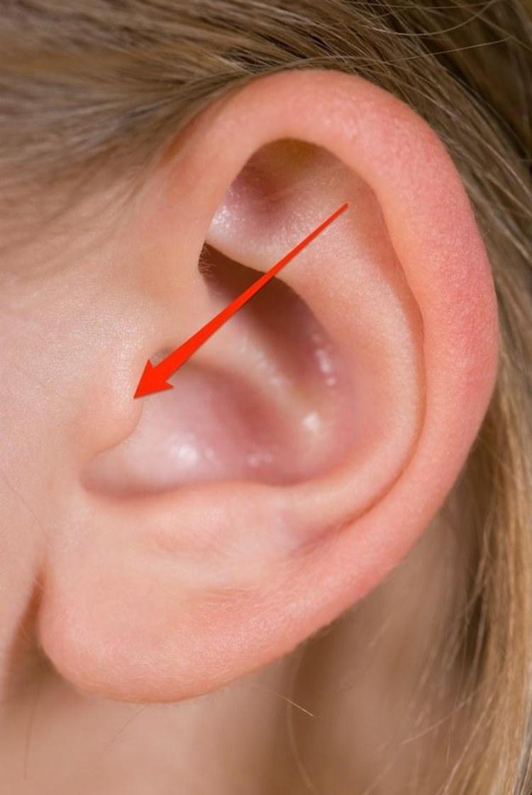Почему уши разные. Отомикоз серная пробка. Отомикоз ушной раковины.