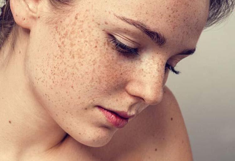 How should women with freckles wear make-up?  - Makeup