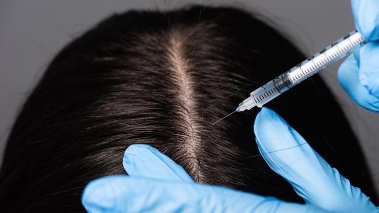 Yazın yıpranan saçlara en özel ve etkili çözüm: Saç mezoterapisi