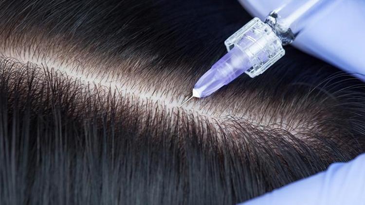Saç mezoterapi ne işe yarar, ne zaman etki gösterir