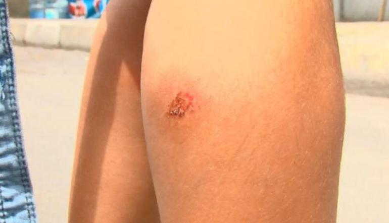 Son dakika İstanbulda sivrisinek paniği Çocuklarda yaralar oluştu
