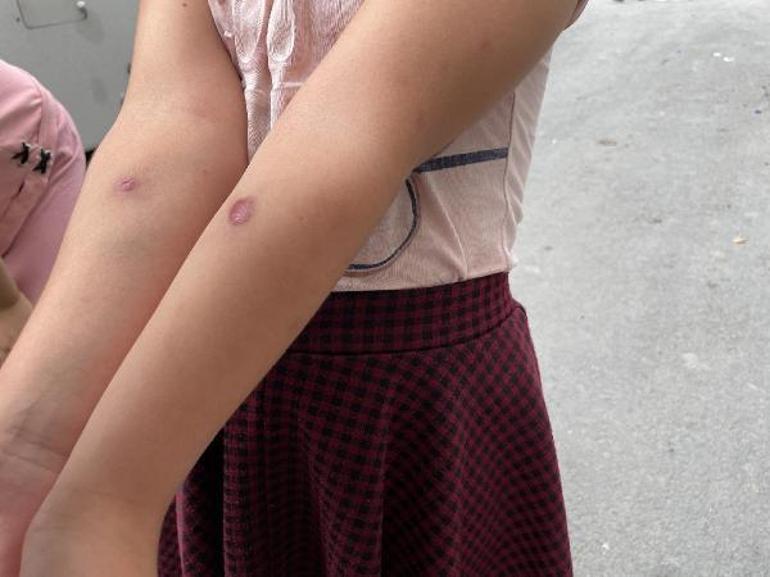 Son dakika İstanbulda sivrisinek paniği Çocuklarda yaralar oluştu